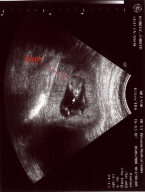Peanut at 12 weeks